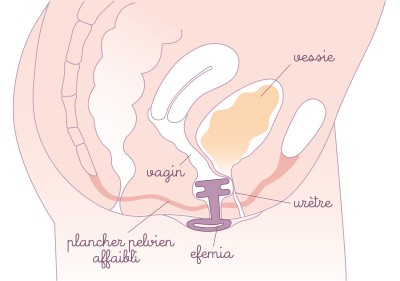 Fonctionnement pessaire pour fuite urinaire Efemia